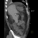 Liver cirrhosis, ascites, portal colonopathy, colopathy: CT - Computed tomography